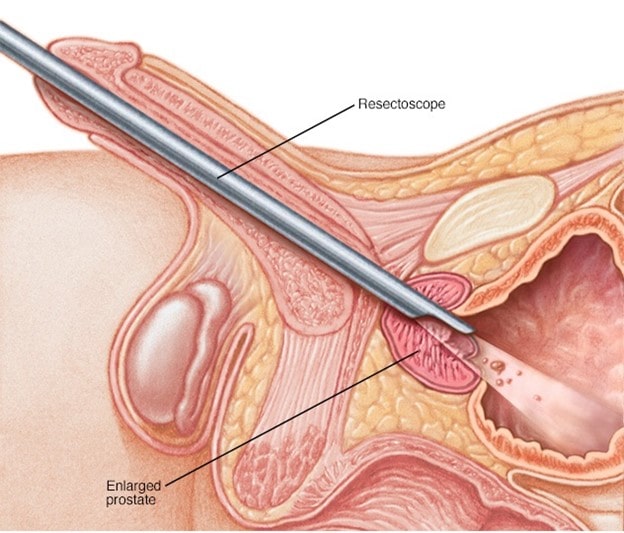جراحی برداشتن پروستات به روش TURP