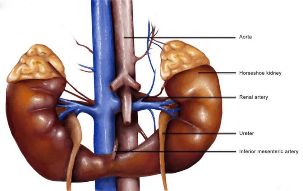 چگونه از کودک مبتلا به کلیه نعل اسبی مراقبت کنیم؟