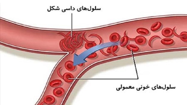 درد کلیه به علت کم ‌خونی سلول داسی شکل