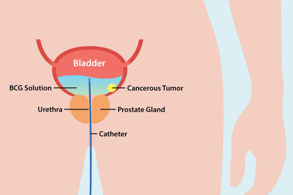 بهترین روش درمان سرطان مثانه