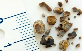 بهترین روش درمان سنگ کلیه