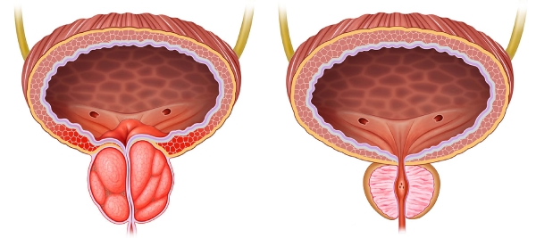 علت بزرگ شدن پروستات