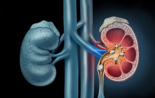 نشانه‌های سنگ کلیه چیست؟
