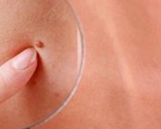 از کجا بفهمم زگیل تناسلی دارم؟