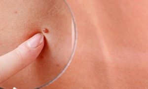 از کجا بفهمم زگیل تناسلی دارم؟