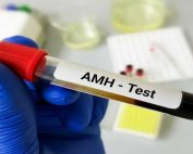 آزمایش AMH چیست ؟