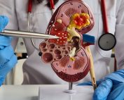 بهترین روش شکستن سنگ کلیه چیست؟