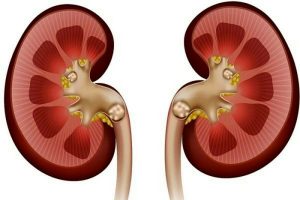 لیزر سنگ کلیه چگونه است؟