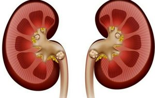 لیزر سنگ کلیه چگونه است؟