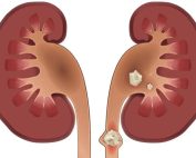 چه زمانی سنگ کلیه نیاز به جراحی دارد؟