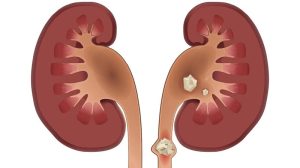 چه زمانی سنگ کلیه نیاز به جراحی دارد؟