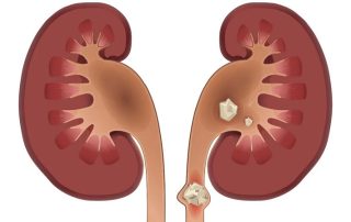چه زمانی سنگ کلیه نیاز به جراحی دارد؟