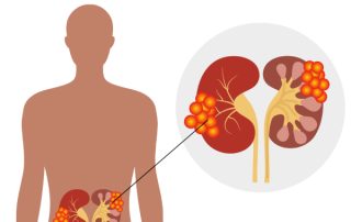 بهترین متخصص اورولوژی سرطان کلیه