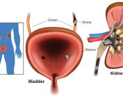 تفاوت سنگ کلیه و سنگ مثانه چیست؟