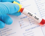 تفسیر آزمایش PSA بر اساس سن