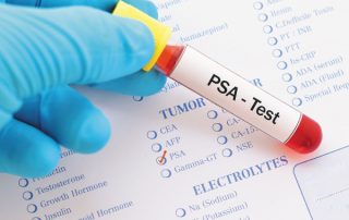 تفسیر آزمایش PSA بر اساس سن