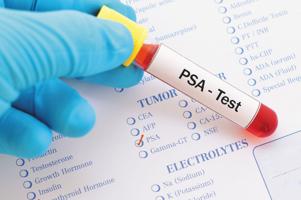 تفسیر آزمایش PSA بر اساس سن
