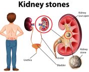 علت تشکیل سنگ کلیه چیست؟