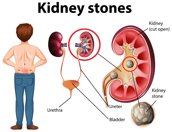 علت تشکیل سنگ کلیه چیست؟