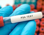 قبل از آزمایش PSA چه نکاتی را رعایت کنیم؟
