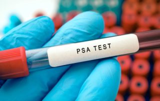 قبل از آزمایش PSA چه نکاتی را رعایت کنیم؟