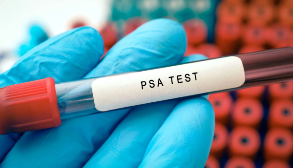 قبل از آزمایش PSA چه نکاتی را رعایت کنیم؟