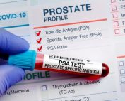 پایین آوردن PSA امکان‌پذیر است؟